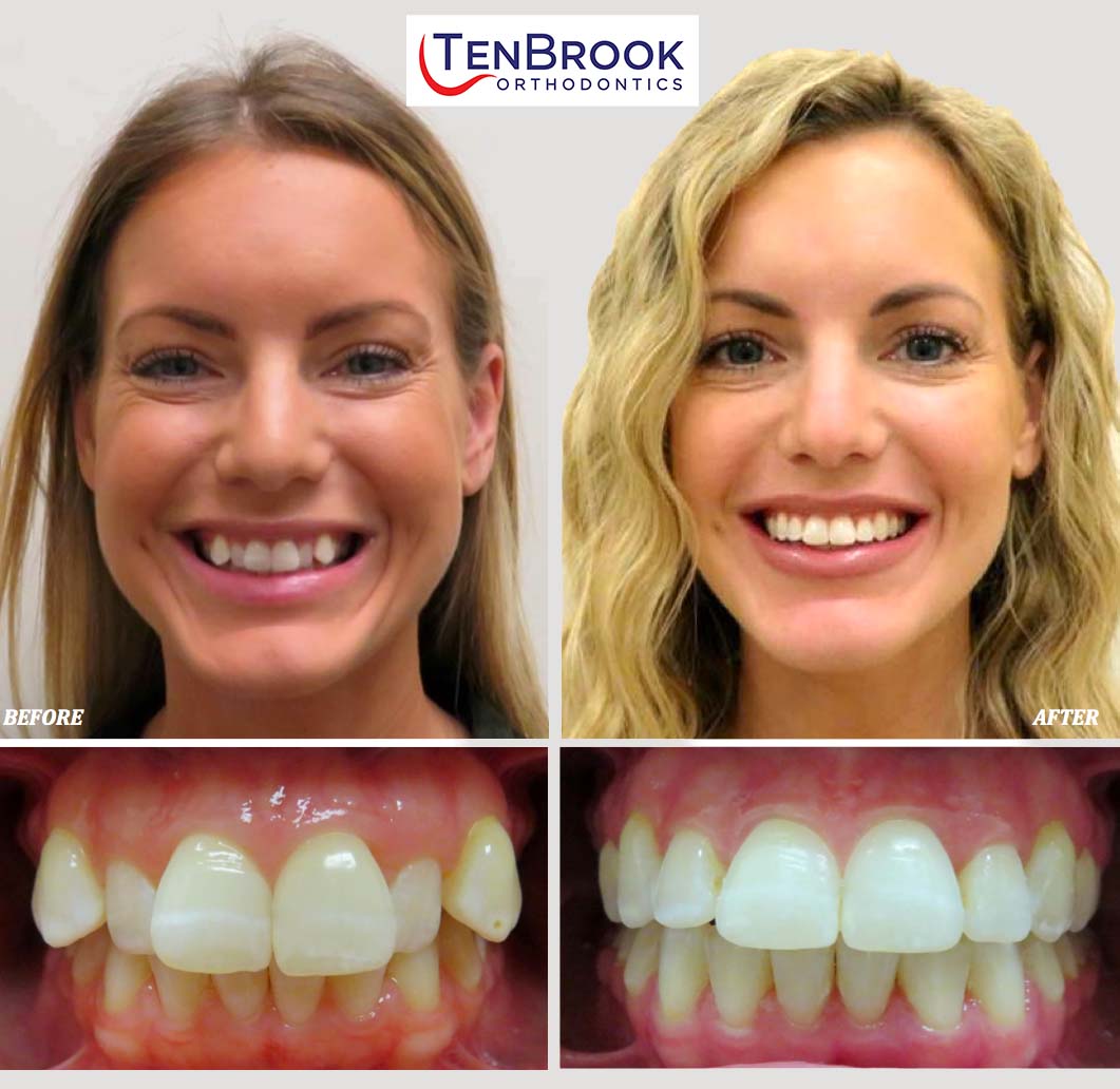 The TenBrook Orthodontics Smile